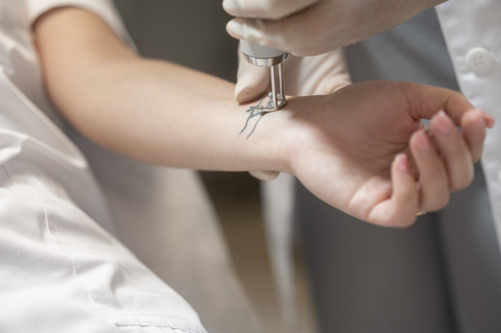 Tatuiruočių / permanentinio makiažo šalinimas lazeriu